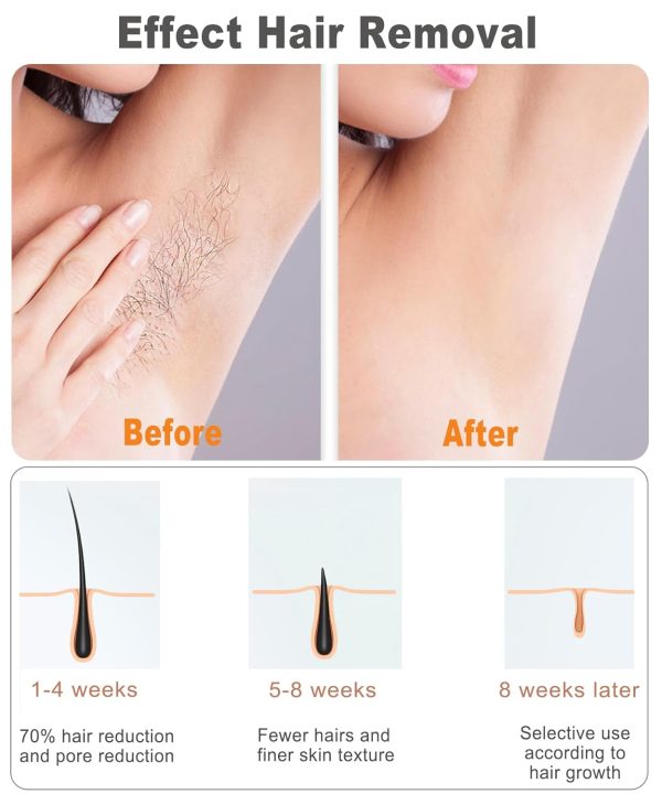 Laser Hair Removal for Women and Men, IPL Hair Remover with Enhanced Ice-Cooling System, Nearly Painless, Long-Lasting Effect, White - Image 4